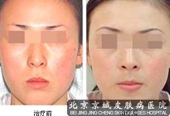 面部发红型红血丝康复案例