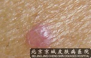 北京皮肤病医院 扁平苔藓 扁平苔藓的病因是什么     扁平苔藓的病因