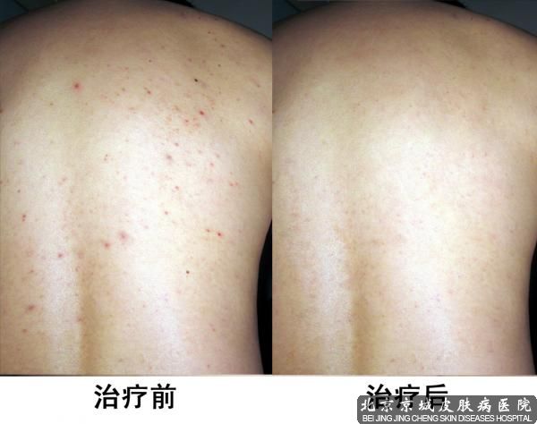 "北京京城皮肤医院指出痘痘长在脸上,它也有可能出现在胸上,背部等