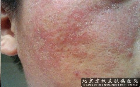 脂溢性皮炎发病一年多了看过医生可是就是不好,最近身上还起湿疹了,也