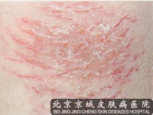 湿疹是日常生活中非常常见的,其病症表现为多样皮疹,并伴有剧烈的瘙痒